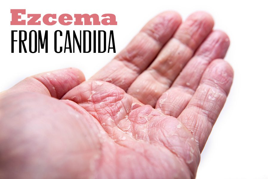 discover-the-eczema-and-candida-connection-home-cures-that-work