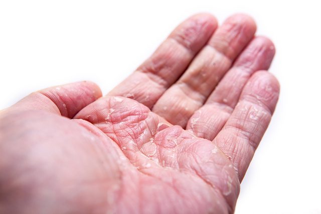 Discover The Eczema And Candida Connection - Home Cures That Work