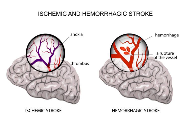 Deadly Stroke Triggers and How to Lower Your Stroke Risk Naturally ...